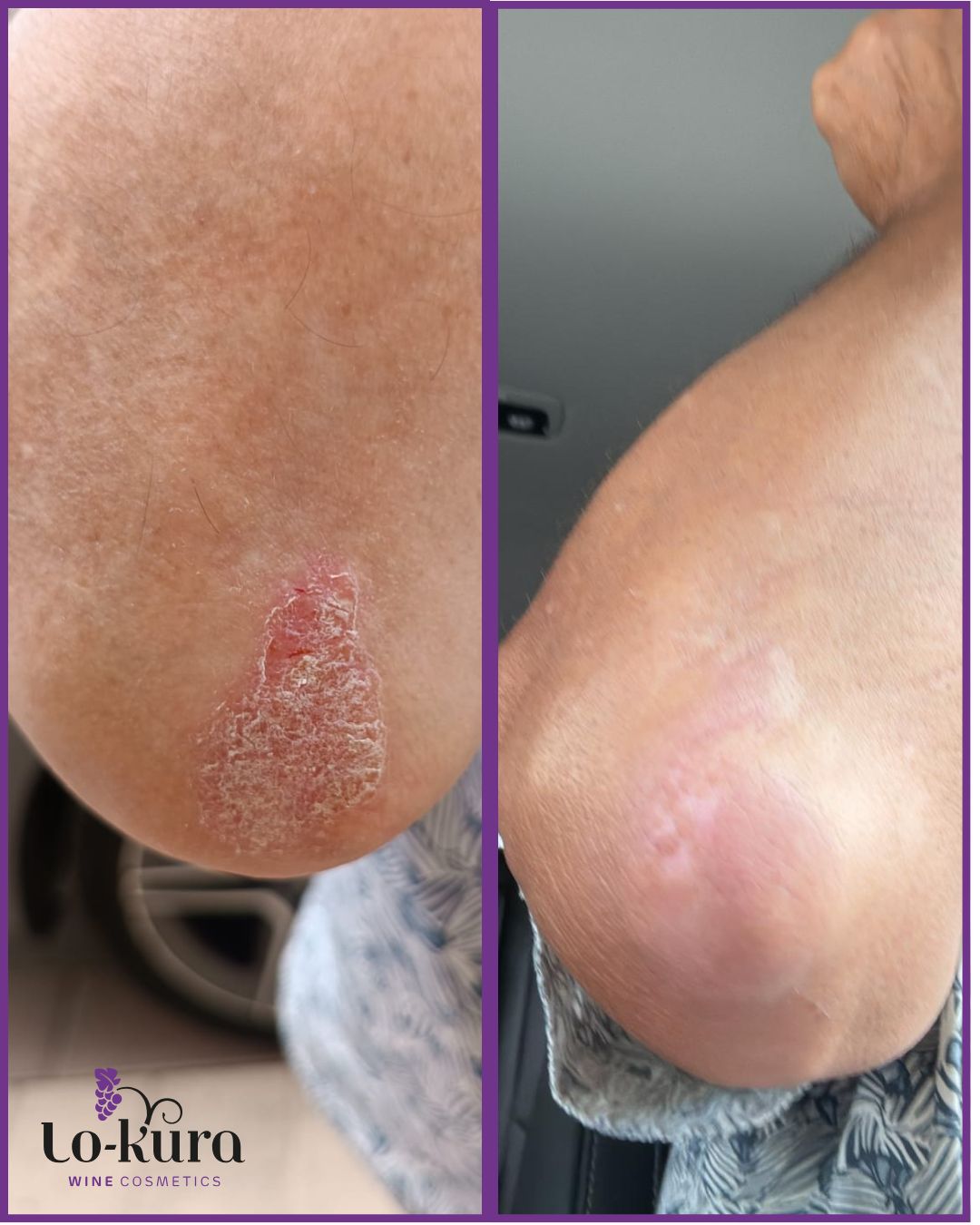 imagen del antes - después de codo con psoriasis y sin ella